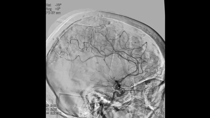 Angiograf&iacute;a por sustracci&oacute;n digital (ASD) 2D con tecnolog&iacute;a ClarityIQ